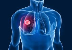 Hepatitler, Karaciğer Kanserini Tetikliyor