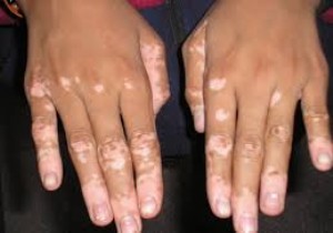 Vitiligo hastalığı ile baş etmenin yolu...