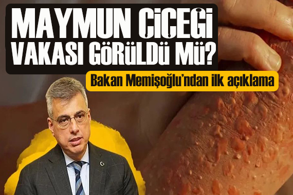 Bakan Memişoğlu ndan yeni açıklama: Maymun çiçeği vakası görüldü mü?