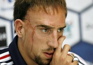 Ribery nin Yüzündeki Yaranın Sebebi Ne? - İŞTE CEVABI - Franck Ribery,Ribery,Yaralı Yüz,Bayern Münih