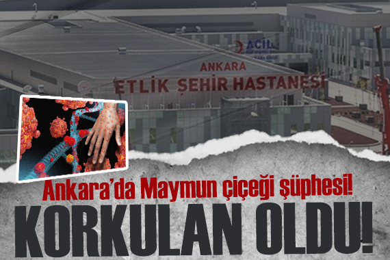 Ankara da Maymun çiçeği şüphesi: 4 kişi karantina altında