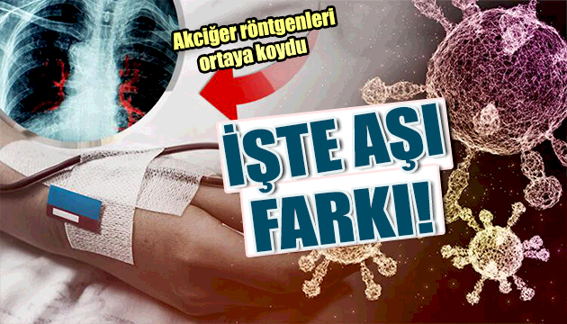 Korona hastalarının aşı farkı röntgen filminde