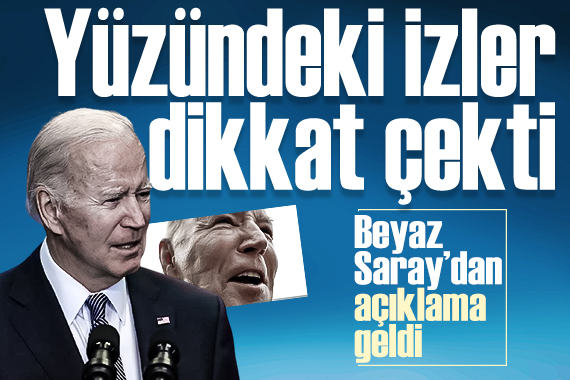 ABD Başkanı Biden ın yüzündeki izler dikkat çekti: Beyaz Saray dan açıklama geldi