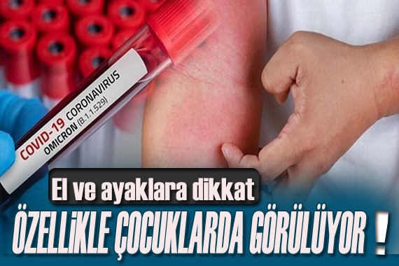 El ve ayaklara dikkat! Özelliklerde çocuklarda görülüyor