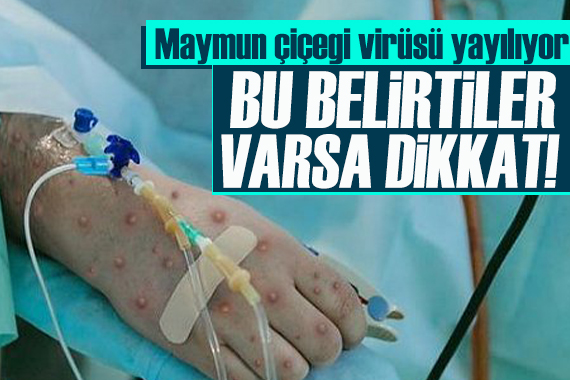 Dünya alarma geçti! Bu şikayetler  maymun çiçeği  belirtisi olabilir